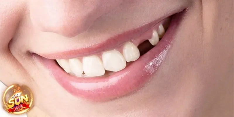 Mơ thấy rụng răng mang ý nghĩa gì đối với người chơi game mỗi ngày